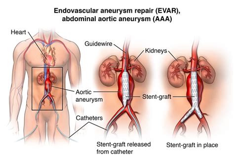 Abdominal Aortic Aneurysm Repair