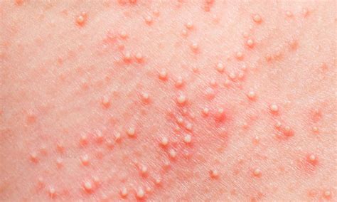 Infectious Folliculitis: Causes, Symptoms and Treatment