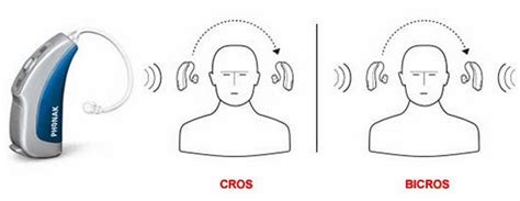 Cros Hearing Aid : Cros Hearing Aid Pros And Cons