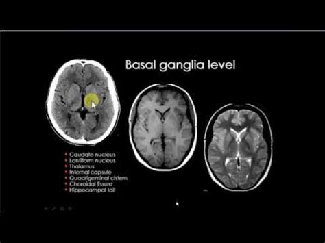 Basal Ganglia Anatomy Ct