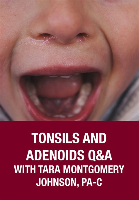 Tonsils and Adenoids Q&A with Tara Montgomery-Johnson, PA-C | Tonsils ...