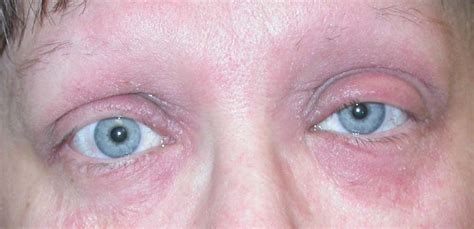 Eyelid Dermatitis (xeroderma of the eyelids, eczema of the eyelids ...