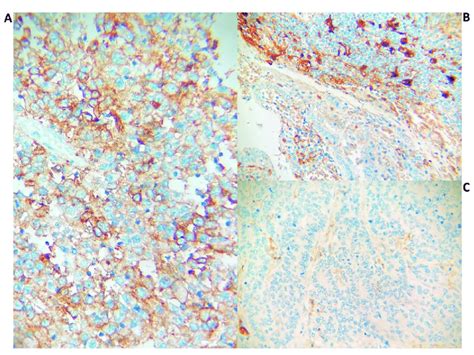 (A). PD-L1 expression in ≥50% of tumour and immune cells (x400). (B ...