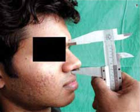 Measurement of nasal height with sliding caliper | Download Scientific Diagram