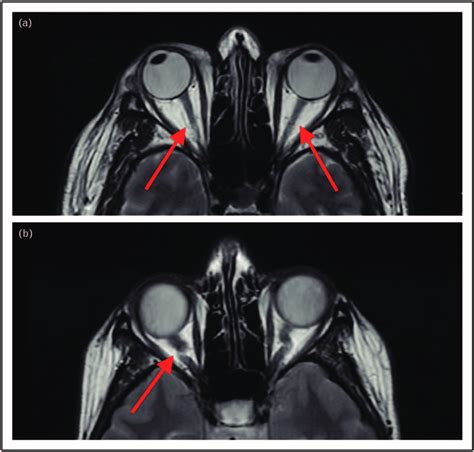 Papilledema Mri