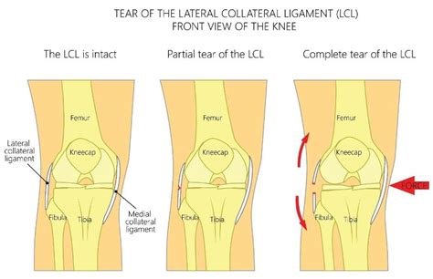 Knee Injuries