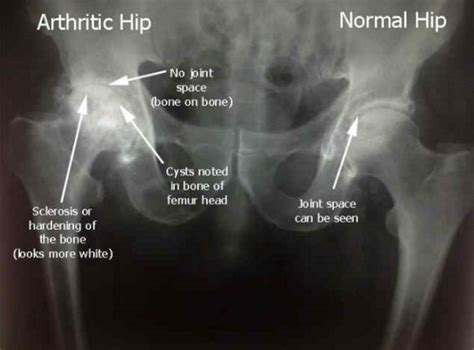 Osteoarthritis - Drwolgin