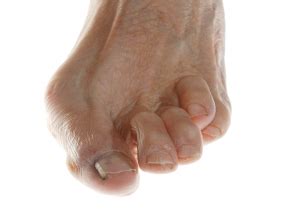 Brachymetatarsia: Causes, Treatment, Lengthening Surgery Info | Footfiles