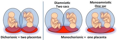 Complicated Monochorionic Twins | Johns Hopkins Center for Fetal ...