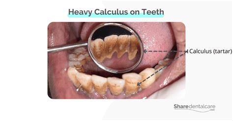 Heavy Calculus on Teeth - Share Dental Care