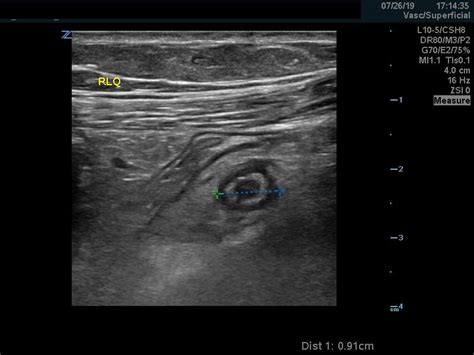 Appendicolith Ultrasound