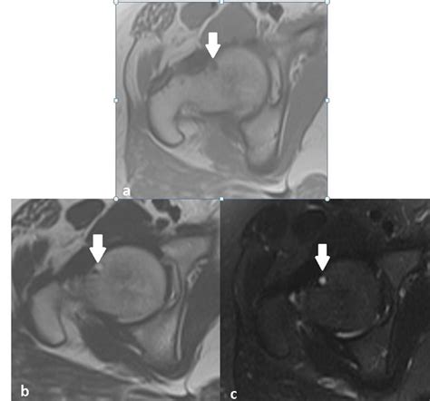 a. Axial T1-weighted image of MR showing the herniation pit at the ...