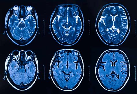 White Matter Lesions and Migraine Disease | National Headache Foundation