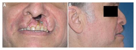 Surgical Reconstruction of Cocaine-Induced Cleft Lip: A Case Report | The Permanente Journal