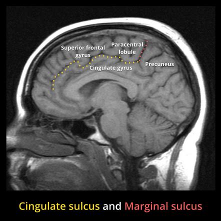 Brain Sulci Labeled