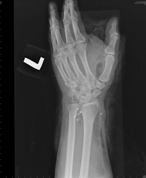 Big Bad: ulnar styloid process fracture and lateral column fracture