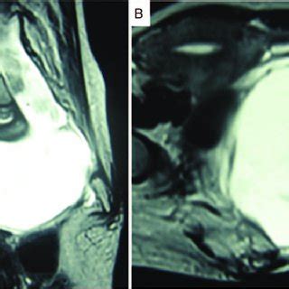 Anterior sacral meningocele in patient 2. Sagittal (A) and axial... | Download Scientific Diagram