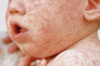 Rashes in babies and children - NHS