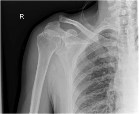 Concomitant coracoid base fracture and acromioclavicular joint disruption: A series of patients ...