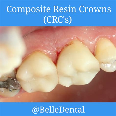 Composite Resin Crowns - BelleDental - July 23, 2020