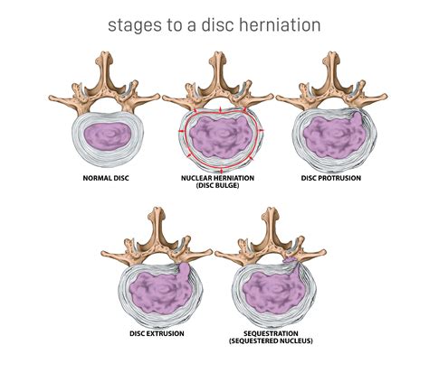 Disc Extrusion Treatment Options - Quotes Trending