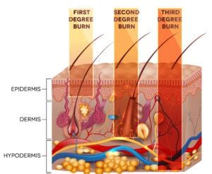 How Are Degree Burns Commonly Caused? | Viles & Beckman, LLC