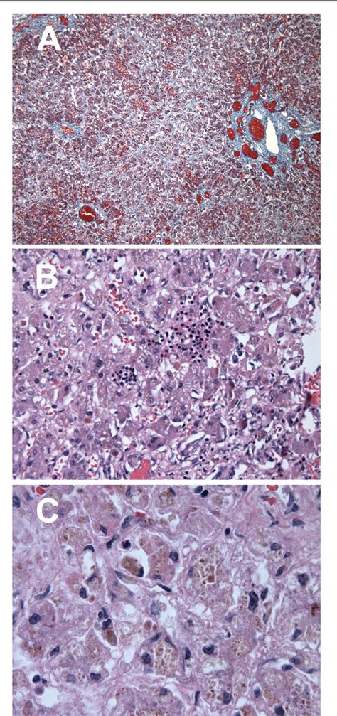 Figure 3 from Perinatal Onset Mevalonate Kinase Deficiency | Semantic Scholar