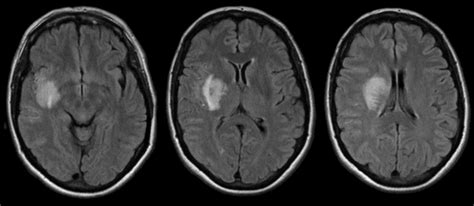 Deep Basal Ganglia and Capsule2a