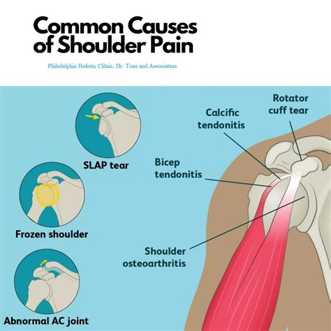 Treatment for Frozen Shoulder - Philadelphia Holistic Clinic - Dr Tsan & Ass