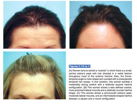 Examples of Female Hairline Variations | Lam, Sam (hairtx.com)