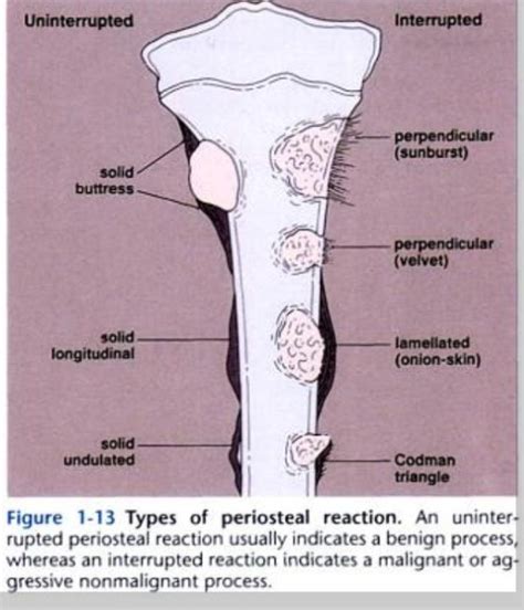 periosteal reaction. uninterrupted usually indicates benign ...