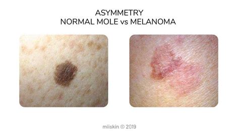 What Does Melanoma Look Like Pictures : What Does Skin Cancer Look Like ...