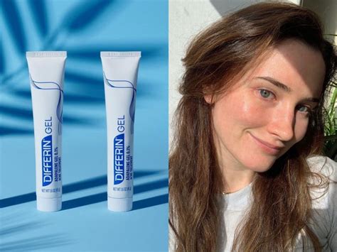 Differin Acne Gel Review: How It Helped Clear up My Skin