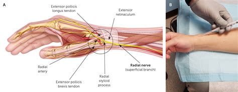 Nerve Blocks: Part I. Upper Extremity | AAFP