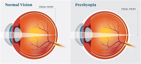 Ekolgöz / Presbyopia