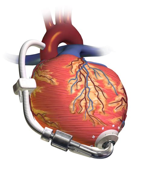 The Rise of the LVAD and the Fall of the eGFR: A Commentary on LVAD Patients Receiving ...