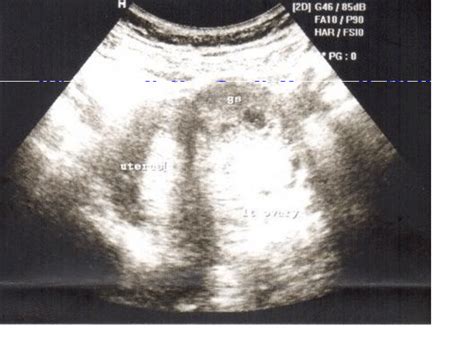 Ultrasound showing interstitial pregnancy | Download Scientific Diagram