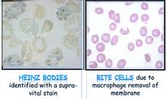 Anemia (Types, Lab) flashcards | Quizlet