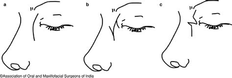 22 Diagrammatic representation of the (a) classical Lynch incision and ...