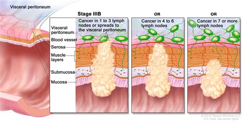 Colon Cancer Stages Symptoms