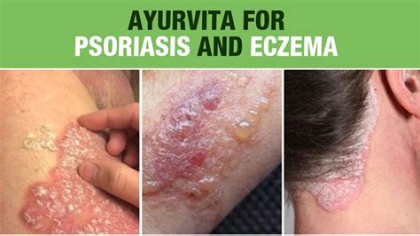 Symptoms of Psoriasis and Eczema - Dr. Vijay Kushvaha - Ayurvita - YouTube