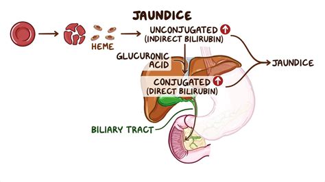 Approach to jaundice (unconjugated hyperbilirubinemia): Clinical ...