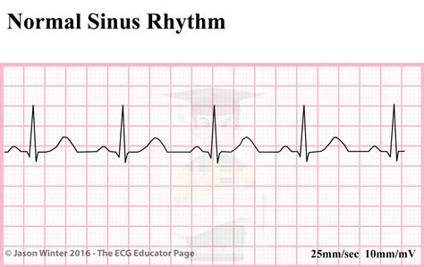 ECG Educator Blog : Sinoatrial Node rhythms