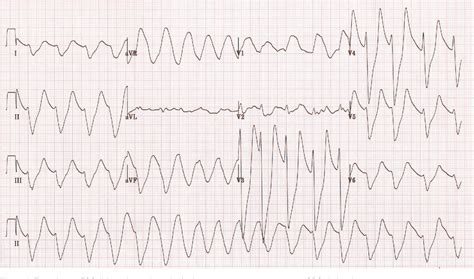 sine wave ecg