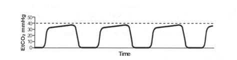 EM Didactic: Capnography beyond ROSC