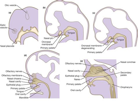 Choanal Atresia - Clinical Features and Treatment