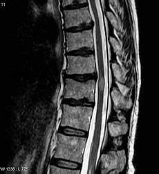 Transverse Myelitis - Physiopedia