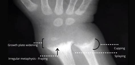 Pediatric Musculoskeletal (MSK) X-ray OSCE - DNB Pediatrics