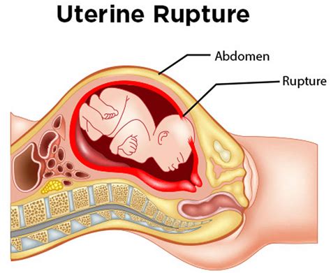 Uterine Rupture | Birth Injury Law Firm