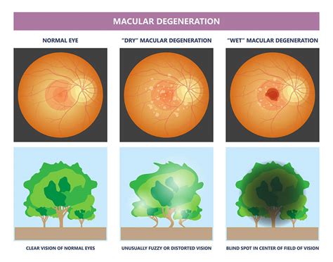 Eye Injections for Macular Degeneration - Ventura County Lasik